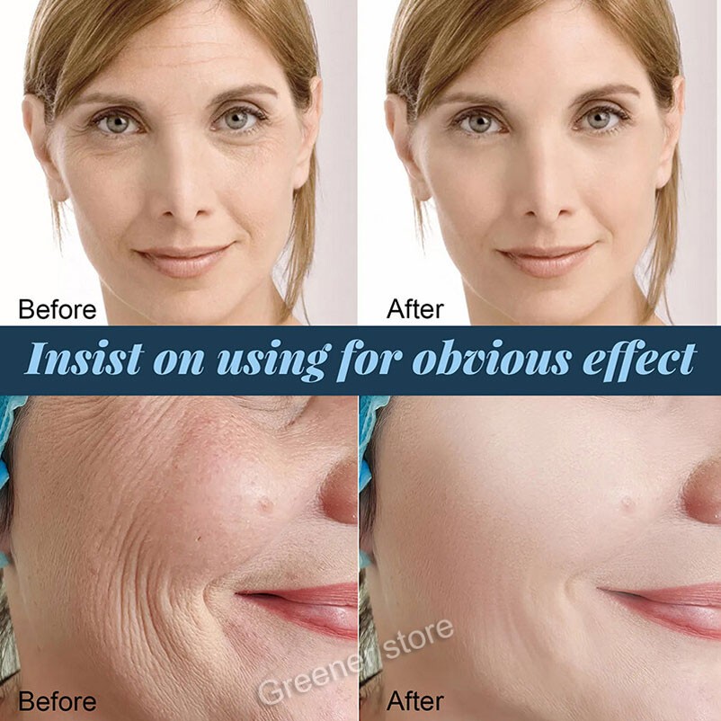 100Pcs Facial Collagen Thread Lift Protein Peptide Line Carving Radar Skin Care