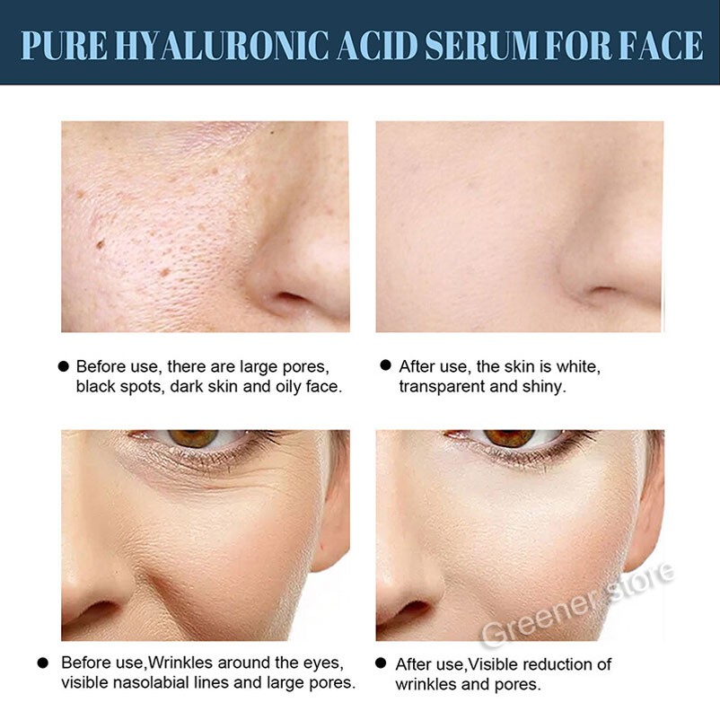 100Pcs Facial Collagen Thread Lift Protein Peptide Line Carving Radar Skin Care