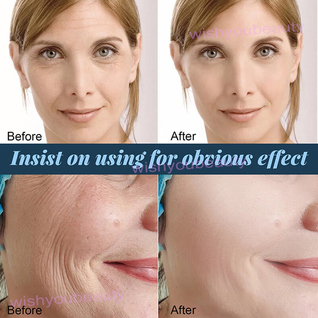 100pcs/Bag Facial Collagen Thread Lift Protein Peptide Line Carving Skin Care